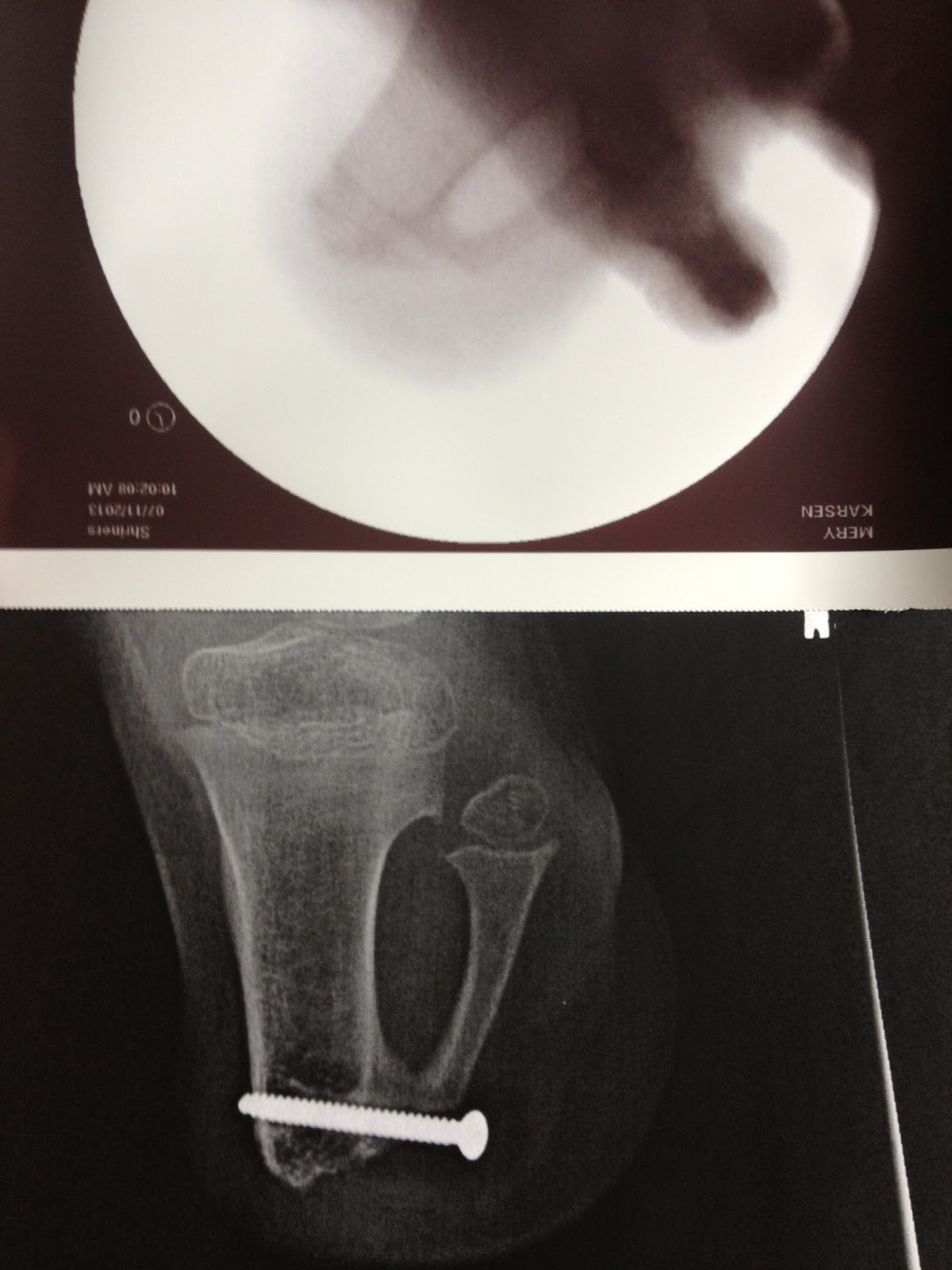 Karsen Mery Screw Removal ) Surgery ??? I think we've all lost count